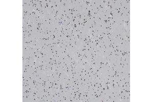 Formalin-fixed, paraffin-embedded human glioma stained withOLIG2 Recombinant Rabbit Monoclonal Antibody (OLIG2/6695R).
