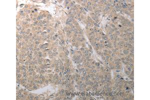 Immunohistochemistry of Human liver cancer using SLC1A4 Polyclonal Antibody at dilution of 1:70 (SLC1A4 anticorps)