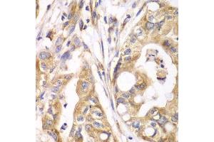 Immunohistochemistry of paraffin-embedded human liver cancer using TXNRD2 antibody.