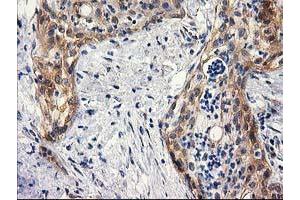 Immunohistochemical staining of paraffin-embedded Carcinoma of Human pancreas tissue using anti-BCAR1 mouse monoclonal antibody. (BCAR1 anticorps)