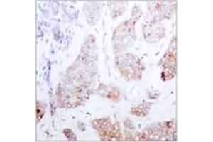 Immunohistochemistry analysis of paraffin-embedded human breast carcinoma tissue, using C-RAF (Ab-259) Antibody. (RAF1 anticorps  (AA 225-274))