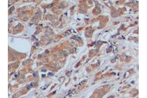 Detection of FN in Human Breast cancer Tissue using Polyclonal Antibody to Fibronectin (FN)