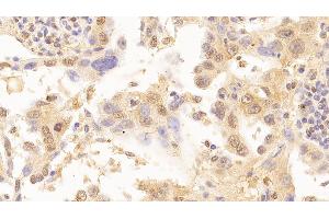 Detection of LMNB1 in Human Lung cancer Tissue using Anti-Lamin B1 (LMNB1) Monoclonal Antibody