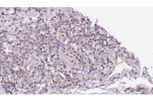 ABIN6273152 at 1/100 staining Human lymph cancer tissue by IHC-P.
