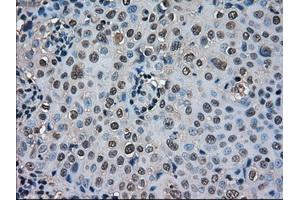 Immunohistochemical staining of paraffin-embedded Carcinoma of thyroid tissue using anti-SOD1mouse monoclonal antibody. (SOD1 anticorps)