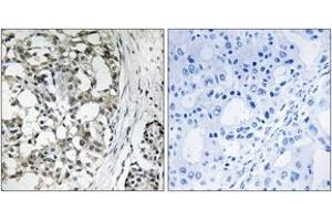 Immunohistochemistry analysis of paraffin-embedded human breast carcinoma tissue, using PEX14 Antibody. (PEX14 anticorps  (AA 117-166))