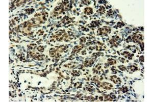 Immunohistochemical staining of paraffin-embedded Human breast tissue using anti-EPM2AIP1 mouse monoclonal antibody. (EPM2AIP1 anticorps)