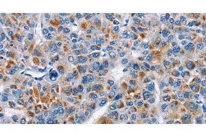 Immunohistochemistry of paraffin-embedded Human liver cancer tissue using CREB2 Polyclonal Antibody at dilution 1:40 (ATF4 anticorps)