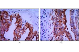 Immunohistochemical analysis of paraffin-embedded ovarian cancer (A), stomach cancer (B) using ALPP mouse mAb with DAB staining.