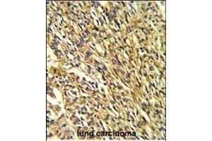 Formalin-fixed and paraffin-embedded human lung carcinoma reacted with KCNJ2 Antibody (C-term), which was peroxidase-conjugated to the secondary antibody, followed by DAB staining.