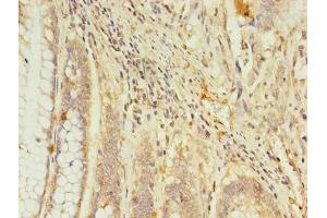 Immunohistochemistry of paraffin-embedded human colon cancer using ABIN7167621 at dilution of 1:100