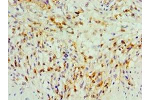 Immunohistochemistry of paraffin-embedded human gallbladder tissue using ABIN7171776 at dilution of 1:100 (TDGF1 anticorps  (AA 35-188))