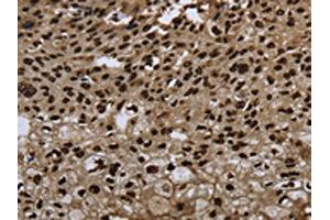 The image on the left is immunohistochemistry of paraffin-embedded Human esophagus cancer tissue using ABIN7189815(ANP32E Antibody) at dilution 1/20, on the right is treated with synthetic peptide. (ANP32E anticorps)