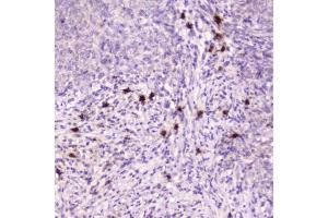 IHC testing of FFPE human sarcoma with Ribonuclease 3 antibody at 2ug/ml. (RNASE3 anticorps  (AA 28-160))