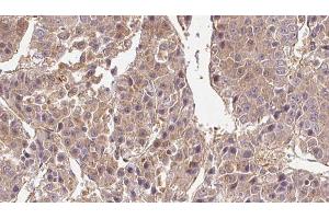 ABIN6269008 at 1/100 staining Human liver cancer tissue by IHC-P.