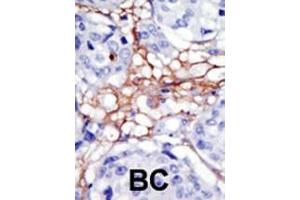 Formalin-fixed and paraffin-embedded human cancer tissue reacted with the primary antibody, which was peroxidase-conjugated to the secondary antibody, followed by DAB staining.
