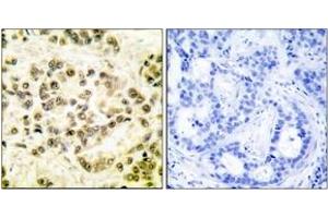 Immunohistochemistry analysis of paraffin-embedded human breast carcinoma, using STAT5B (Phospho-Ser731) Antibody. (STAT5B anticorps  (pSer731))