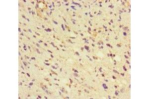 Immunohistochemistry of paraffin-embedded human glioma using ABIN7154022 at dilution of 1:100 (GLUL anticorps  (AA 86-373))