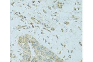 Immunohistochemistry of paraffin-embedded Human breast cancer using MTFP1 Polyclonal Antibody at dilution of 1:100 (40x lens). (Mtfp1 anticorps)