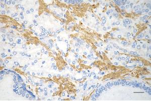 Immunohistochemistry was performed on paraffin-embedded human prostatic adenocarcinoma using desmin antibody (ABIN7798314), 1:200). (Recombinant Desmin anticorps)