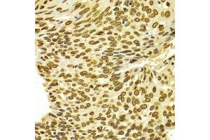 Immunohistochemistry of paraffin-embedded human esophageal cancer using Lamin A/C antibody.