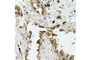 Immunohistochemistry of paraffin-embedded human lung cancer using HSP70/HSP antibody (2948) at dilution of 1:100 (40x lens).