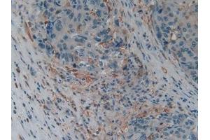 Detection of GSN in Human Liver cancer Tissue using Polyclonal Antibody to Gelsolin (GSN)