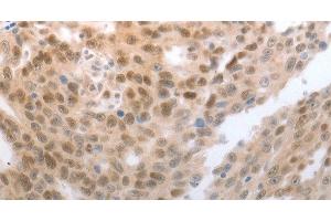 Immunohistochemistry of paraffin-embedded Human esophagus cancer tissue using SLC22A8 Polyclonal Antibody at dilution 1:70