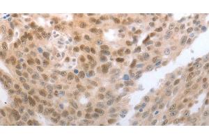 Immunohistochemistry of paraffin-embedded Human esophagus cancer tissue using SLC22A8 Polyclonal Antibody at dilution 1:70 (SLC22A8 anticorps)