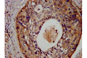 IHC image of ABIN7174093 diluted at 1:300 and staining in paraffin-embedded human cervical cancer performed on a Leica BondTM system.