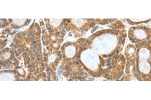 Immunohistochemistry of paraffin-embedded Human thyroid cancer tissue using KANSL1L Polyclonal Antibody at dilution of 1:80(x200) (KANSL1L anticorps)