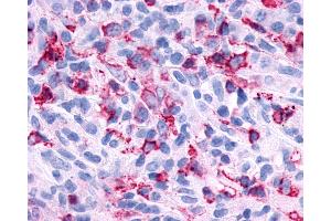 Anti-P2RY6 / P2Y6 antibody IHC of human Lymph Node, Non-Hodgkins Lymphoma.