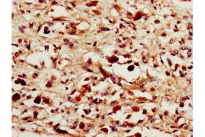 IHC image of ABIN7156872 diluted at 1:1400 and staining in paraffin-embedded human melanoma performed on a Leica BondTM system. (IL-24 anticorps  (AA 52-207))
