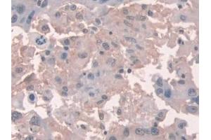 Detection of NOX1 in Human Breast cancer Tissue using Polyclonal Antibody to Nicotinamide Adenine Dinucleotide Phosphate Oxidase 1 (NOX1) (NOX1 anticorps  (AA 235-488))