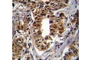 CAD antibody immunohistochemistry analysis in formalin fixed and paraffin embedded human breast carcinoma. (CAD anticorps  (AA 780-809))