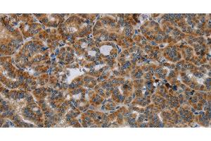 Immunohistochemistry of paraffin-embedded Human thyroid cancer tissue using HSD17B14 Polyclonal Antibody at dilution 1:40 (HSD17B14 anticorps)