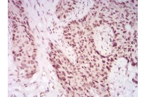 Immunohistochemical analysis of paraffin-embedded cervical cancer tissues using CBX2 mouse mAb with DAB staining.