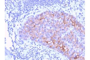 Formalin-fixed, paraffin-embedded human Breast Carcinoma stained with HER-2 Mouse Monoclonal Antibody (ERBB2/3078). (ErbB2/Her2 anticorps  (AA 311-462))