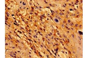 Immunohistochemistry of paraffin-embedded human cervical cancer using ABIN7172450 at dilution of 1:100 (TCF15 anticorps  (AA 24-199))