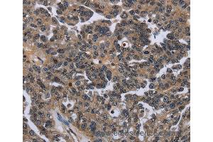 Immunohistochemistry of Human ovarian cancer using ITGAE Polyclonal Antibody at dilution of 1:50 (CD103 anticorps)