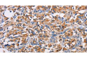 Immunohistochemistry of paraffin-embedded Human thyroid cancer tissue using PIM2 Polyclonal Antibody at dilution 1:40 (PIM2 anticorps)
