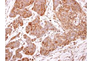 IHC-P Image ARF5 antibody detects ARF5 protein at cytosol on human breast carcinoma by immunohistochemical analysis. (ARF5 anticorps)