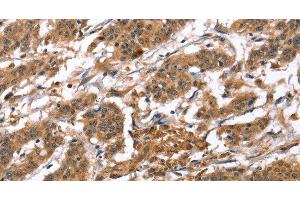 Immunohistochemistry of paraffin-embedded Human gastric cancer tissue using BNIP2 Polyclonal Antibody at dilution 1:50 (BNIP2 anticorps)