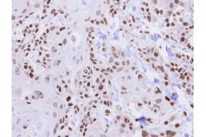 IHC-P Image Immunohistochemical analysis of paraffin-embedded CA922 xenograft , using HUS1, antibody at 1:500 dilution.