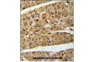 RT4I1 Antibody (C-term) (ABIN654729 and ABIN2844417) immunohistochemistry analysis in formalin fixed and paraffin embedded human hepatocarcinoma followed by peroxidase conjugation of the secondary antibody and DAB staining. (RTN4IP1 anticorps  (C-Term))