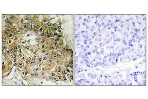 Immunohistochemical analysis of paraffin-embedded human breast carcinoma tissue using Integrin β1 (Phospho-Thr789) antibody (left)or the same antibody preincubated with blocking peptide (right).