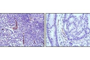 Immunohistochemical analysis of paraffin-embedded human lymph node (left) and colon cancer (right) tissues using eNOS mouse mAb with DAB staining. (ENOS anticorps)