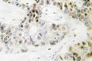 Immunohistochemistry (IHC) analyzes of Pitx1 antibody in paraffin-embedded human lung carcinoma tissue. (PITX1 anticorps)