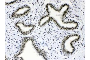 IHC testing of FFPE human breast cancer tissue with Musashi antibody at 1ug/ml.
