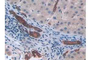 IHC-P analysis of Human Liver cancer Tissue, with DAB staining. (CXCL2 anticorps  (AA 34-107))